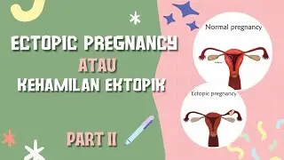 PENGALAMAN HAMIL DI LUAR KANDUNGAN!!!