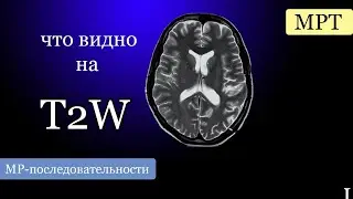 Базовые видео  по МРТ / МР-последовательности: T2W
