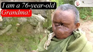 Born Without a Face - I Got Married and Had 2 Children! ~ Body Bizarre!