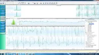 KTresult3 разбор морфологии QRS
