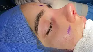 Rhinoplasty