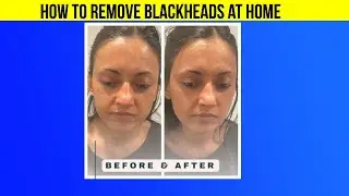 How To Remove Blackheads At Home With Egg