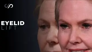 Top Eyelid Surgeon Reveals Amazing Before and After Results