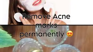 Remove acne marks permanently Facepack|acne scars|acne scar removal|how to remove acne|acne removal