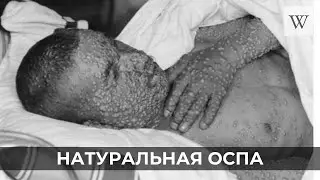 Натуральная оспа | Аудио Википедия | Audio Wikipedia