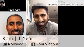 Hair Loss Treatment Before and After -  
