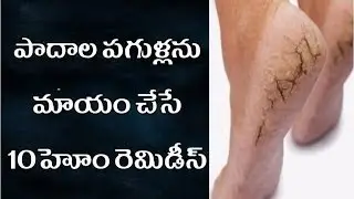పాదాల పగుళ్లను మాయం చేసే మిరాకిల్ 10 హోం రెమెడీస్ | padhalu pagilina mayam chesa miracle?