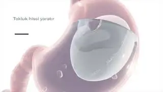 Allurion Mide Balonu ile Hedefinize Ulaşın!