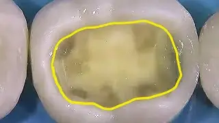 Aesthetic restoration of the chewing surface!