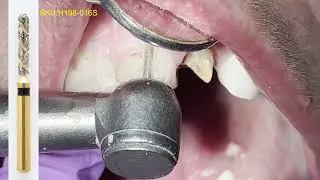 Removing And Replacing An Old Ceramic Crown