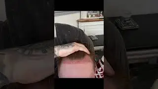 Hair transplant journey (18months)