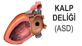 ASD (Atriyal Septal Defekt) | Kalp Deliği