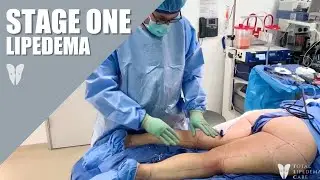 Stage One Lipedema | Manual Lipedema Extraction | Lipedema Reduction Surgery | Total Lipedema Care