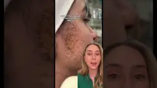 Laser Hair Removal Burn! 