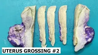 Uterus grossing #2 - endometrial cancer