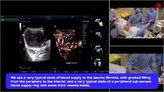 Microwave Ablation for Uterine Fibroids