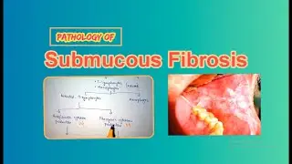Pathology Of  Oral Submucous Fibrosis (OSF). Pathogenesis of Submucous Fibrosis.