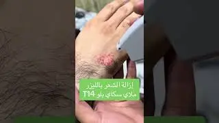 جهاز ممتاز لإزالة الشعر بالليزر IPL، أنت تستحقينه