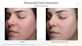 AlphaRet Clearing Serum Application Video