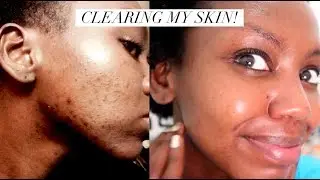 CLEARING MY SKIN - I tried the 10 Step Korean Skin Care Routine || Patricia Kihoro