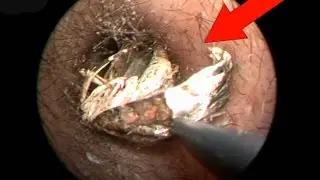 Ужас! 7 Случаев когда Насекомые Залезли в Уши Людям