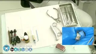Кариес класс -V 26 EvoCeram Syntac Sanctuary TorVM (прямой эфир)