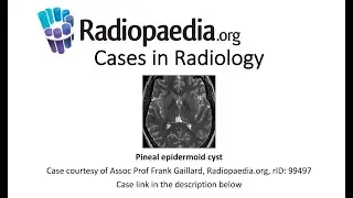 Pineal epidermoid cyst (Radiopaedia.org) Cases in Radiology