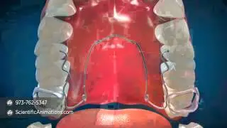 Quad Helix - Dental Procedures