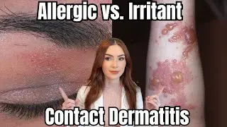 Irritant Vs. Allergic Contact Dermatitis | How to Tell the Difference