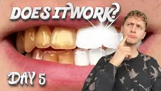 Testing out the ‘viral’ TEETH WHITENING STRIPS (Day 5)