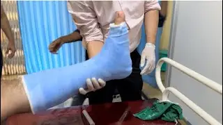 Fibrecast/articast/fibreglass below knee cast for lateral malleolus fracture #conservative #blue