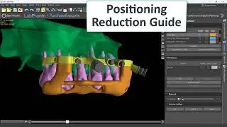 Stackable Guide Workflow in Blue Sky Plan (Timelapse)