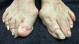 Podiatric nail debridement @LloydPodiatryGroup