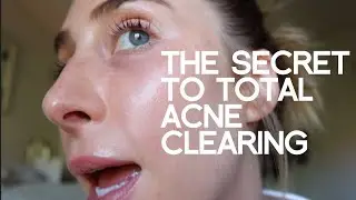 Progressive overload for acne clearing. (Why isn't anyone talking about this??)