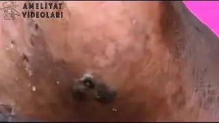 En iğrenç 20 Yıllık Siyah Noktalar Sivilceler(Video Sonuna kadar dayanamazsınız!)