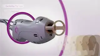 Candela GentleMax Pro - Alexandrite + Nd:Yag