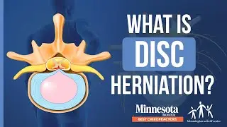 What Is Disc Herniation? │ Bloomington Wellness Center