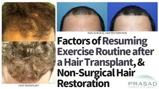 Factors in Resuming Exercise after a Hair Transplant, and Faster Return from Non-Surgical Treatment
