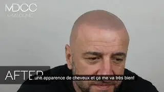 Ceci n'est pas un tatouage de base: Le traitement ultra sophistiqué de la Micropigmentation Cheveux