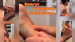 Косолапие, вальгус, плоскостопие. Не приговор!