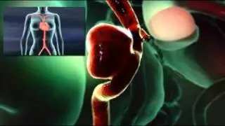 Endovascular Treatment for Cerebral Aneurysms