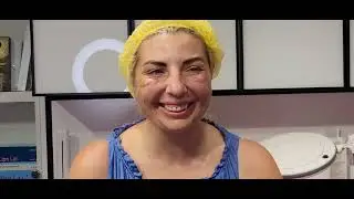 Филлеры все лицо.
