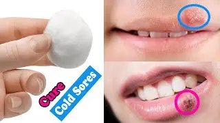 How to Get Rid of  Cold Sores Or Fever Blister Fast & Naturally / Prevent Cold Sores Instantly
