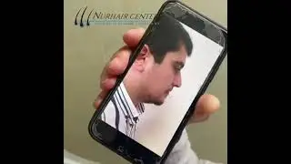 Турецкий центр пересадки волос в Махачкале. REMED NUR HAİR.