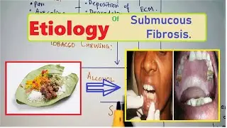 What Areca Nuts (Pan) can cause to you ? Etiology Of submucous Fibrosis