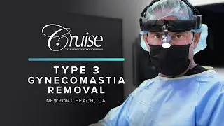 Gynecomastia Breast Tissue Removal Newport Beach Plastic Surgeon