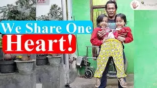 Conjoined Twins Putri and Dewi: Fighting with One Heart ❤️! ~ Body Bizarre!