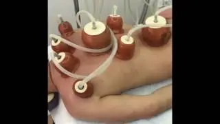 Банки на спину.Вакуумотерапия.