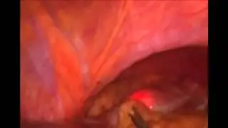 Omental Patch Peptic Ulcer Repair