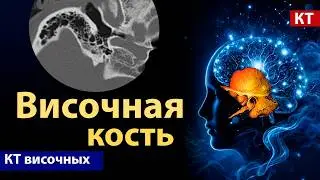 КТ височной кости: анатомия, в которой легко запутаться